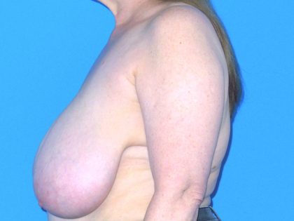 Breast Reduction Before & After Patient #1922