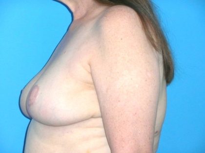 Breast Reduction Before & After Patient #1922