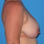 Breast Reduction Before & After Patient #1933