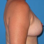 Breast Reduction Before & After Patient #1933