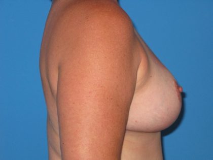 Breast Reduction Before & After Patient #1933