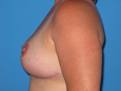 Breast Reduction Before & After Patient #1933