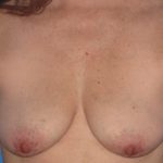 Breast Augmentation with Lift Before & After Patient #1668
