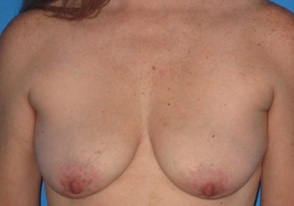 Breast Augmentation with Lift Before & After Patient #1668
