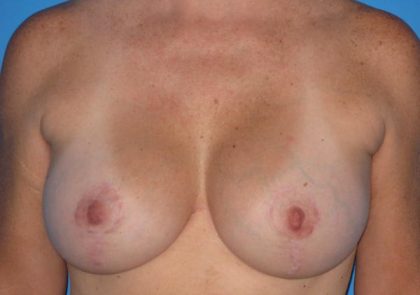 Breast Augmentation with Lift Before & After Patient #1668