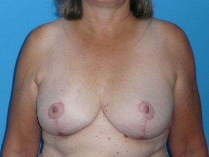 Breast Reduction Before & After Patient #1944