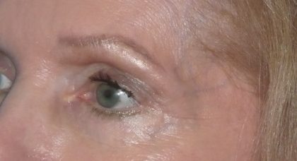 Brow Lift Before & After Patient #2118