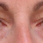 Blepharoplasty Before & After Patient #2179