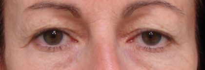 Blepharoplasty Before & After Patient #2179