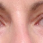 Blepharoplasty Before & After Patient #2179