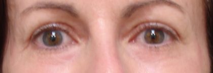 Blepharoplasty Before & After Patient #2179
