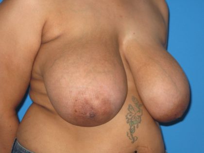 Breast Reduction Before & After Patient #1947