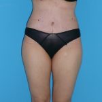 Tummy Tuck Before & After Patient #2153