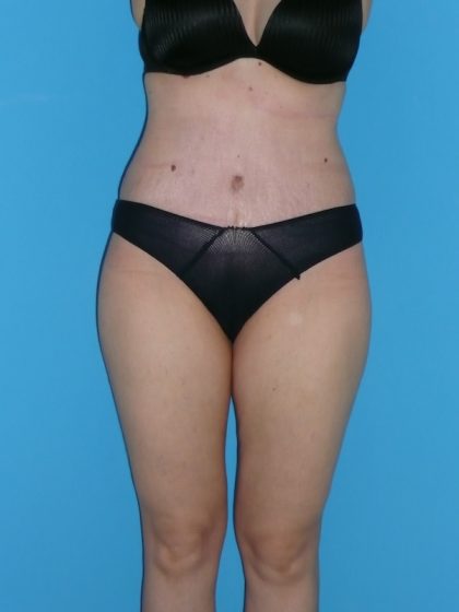 Tummy Tuck Before & After Patient #2153