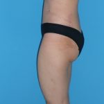 Tummy Tuck Before & After Patient #2153