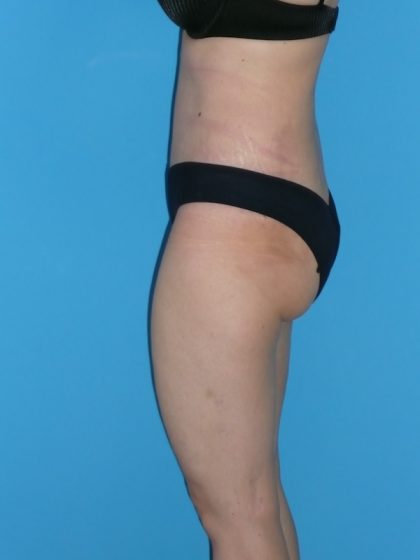 Tummy Tuck Before & After Patient #2153