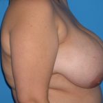 Breast Reduction Before & After Patient #1954