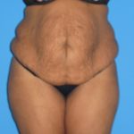 Tummy Tuck Before & After Patient #2160