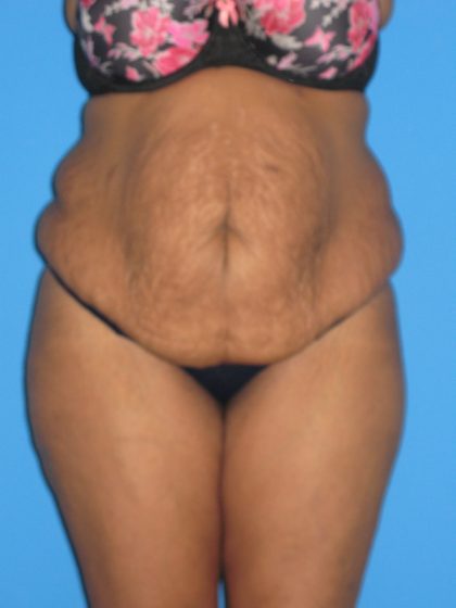 Tummy Tuck Before & After Patient #2160