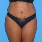 Tummy Tuck Before & After Patient #2160