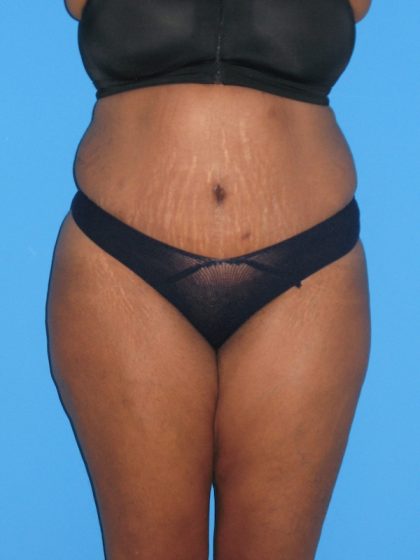 Tummy Tuck Before & After Patient #2160