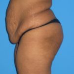 Tummy Tuck Before & After Patient #2160