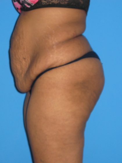 Tummy Tuck Before & After Patient #2160