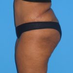 Tummy Tuck Before & After Patient #2160