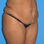 Tummy Tuck Before & After Patient #2160