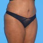 Tummy Tuck Before & After Patient #2160