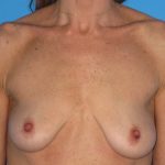 Breast Augmentation with Lift Before & After Patient #1684