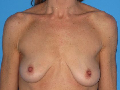 Breast Augmentation with Lift Before & After Patient #1684