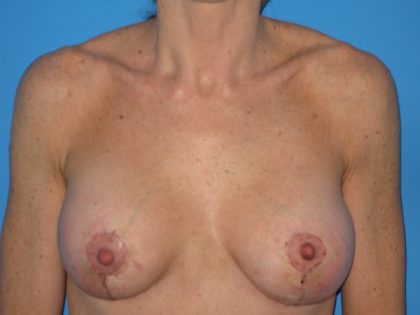 Breast Augmentation with Lift Before & After Patient #1684