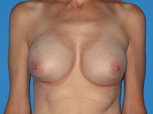 Implant Exchange Before & After Patient #1771