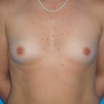 Breast Augmentation Before & After Patient #1591