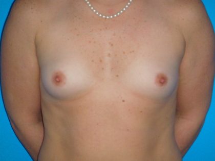 Breast Augmentation Before & After Patient #1591