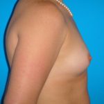 Breast Augmentation Before & After Patient #1591