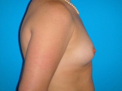 Breast Augmentation Before & After Patient #1591
