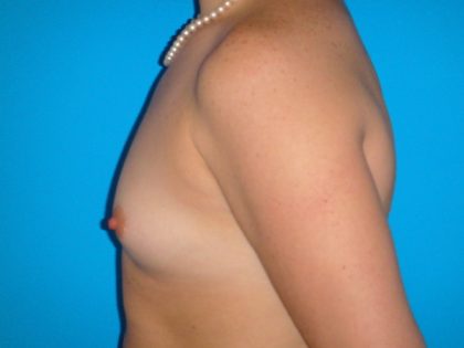 Breast Augmentation Before & After Patient #1591