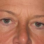 Blepharoplasty Before & After Patient #2182