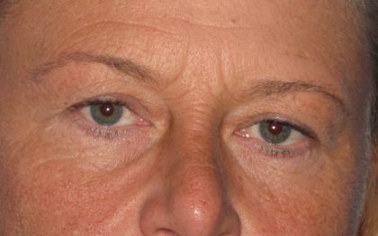 Blepharoplasty Before & After Patient #2182