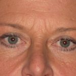 Blepharoplasty Before & After Patient #2182