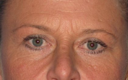 Blepharoplasty Before & After Patient #2182