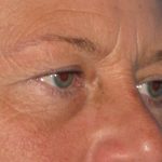 Blepharoplasty Before & After Patient #2182