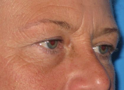 Blepharoplasty Before & After Patient #2182