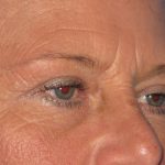 Blepharoplasty Before & After Patient #2182