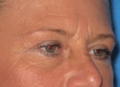 Blepharoplasty Before & After Patient #2182