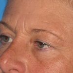 Blepharoplasty Before & After Patient #2182