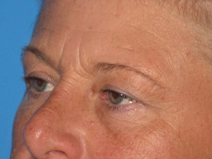 Blepharoplasty Before & After Patient #2182