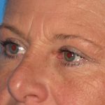 Blepharoplasty Before & After Patient #2182